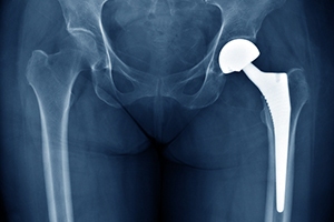 Wright Medical Hip Replacements