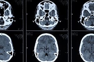 Encephalopathy