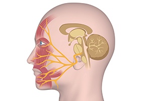 Facial Palsy