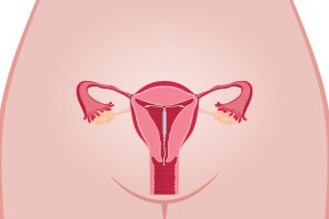 Problems with the Paragard IUD