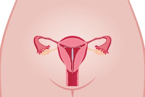 Problems with the Paragard IUD