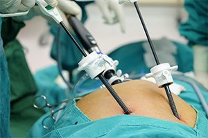 Laparoscopic Cholecystectomy Malpractice