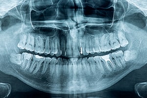 Panoramic Dental X-Ray